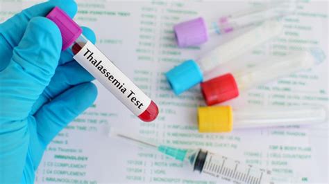 xét nghiệm thalassemia hết bao nhiều tiền